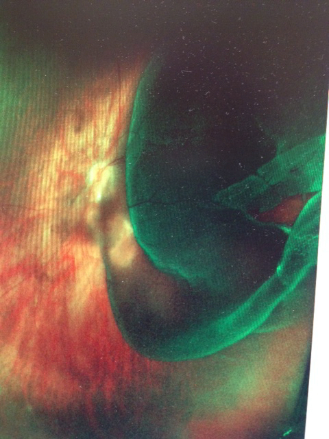 image of retina showing scar tissue and large areas of damage
