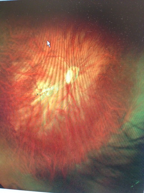 Image of a normal retina